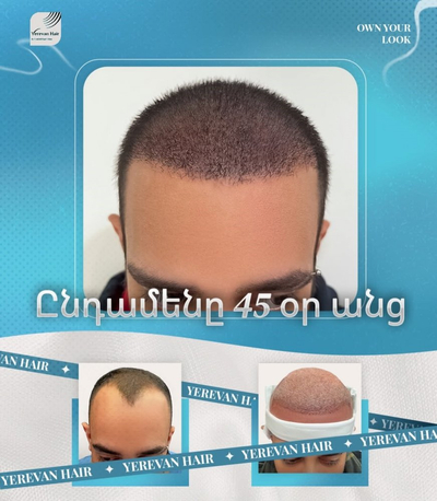 Slider image (1) United Hair Clinic